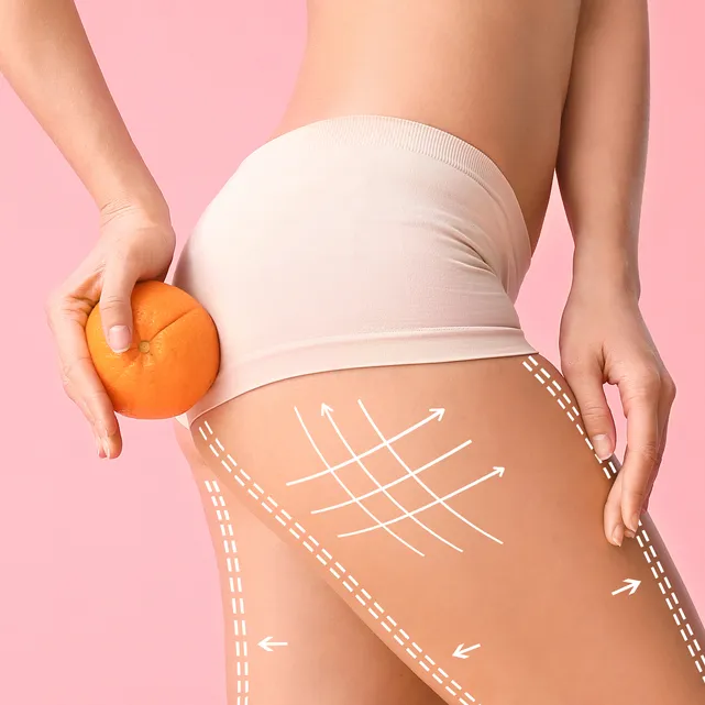Cellulite-Behandlung